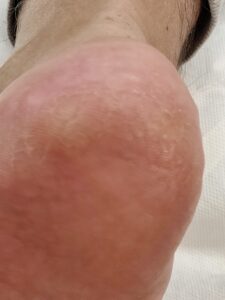 After 2 - Pedicure