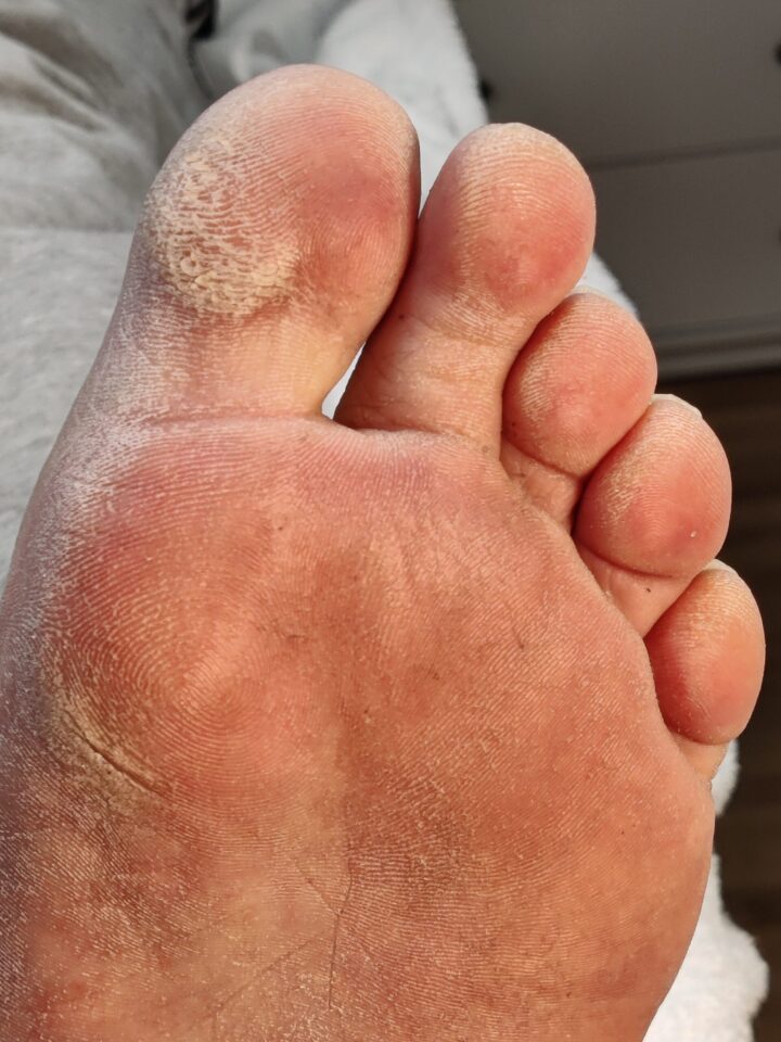 Before 1 – Pedicure