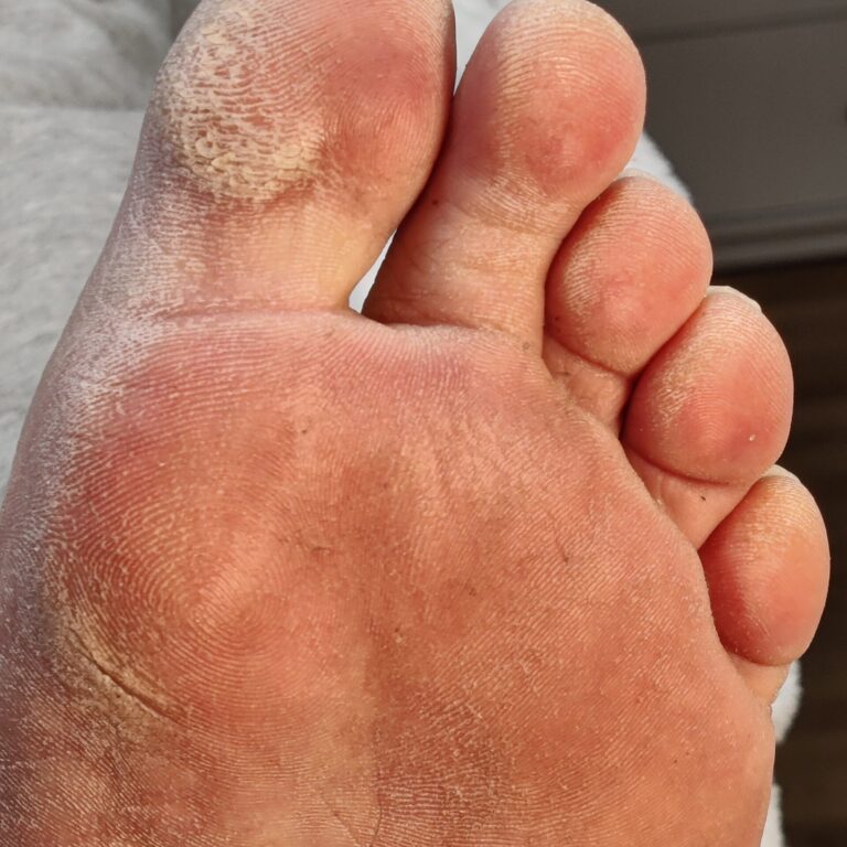 Before 1 – Pedicure