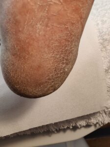 Before 2 - Pedicure