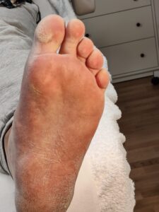 Before 3 - Pedicure